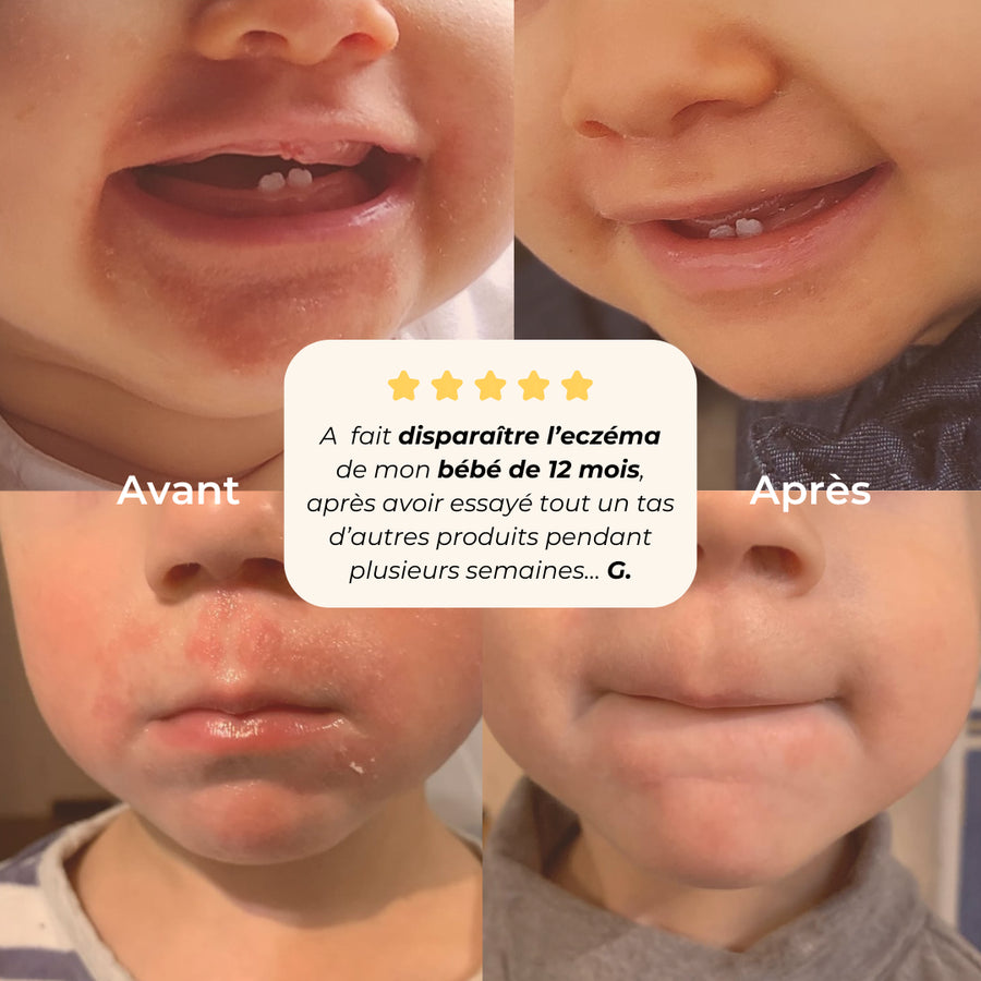 solution naturelle eczéma bébé