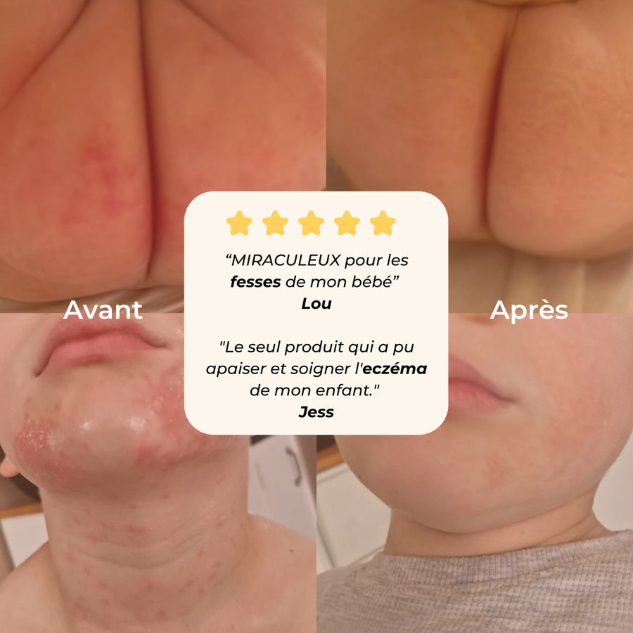 solution naturelle eczéma bébé fesse erythème fessier