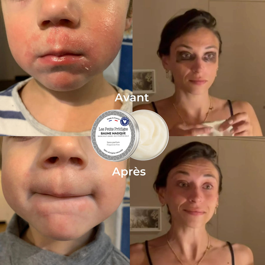 Avant/Après Baume Magique Avis Client Démaquillant Eczéma
