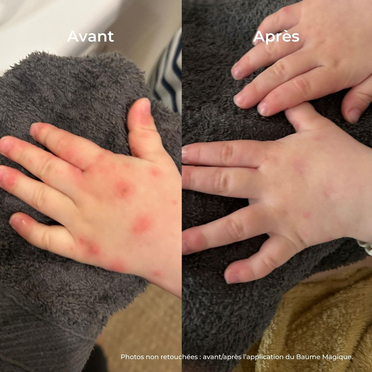 Main d'enfant avec plaques rouges avant et peau apaisée après le Baume Magique