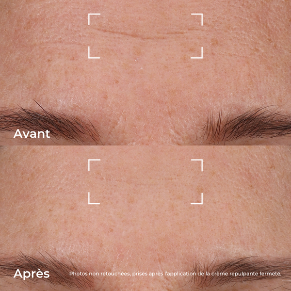 Avant/après application de la Crème Repulpante Fermeté, montrant l’effet lissant sur les rides du front. Photos non retouchées.