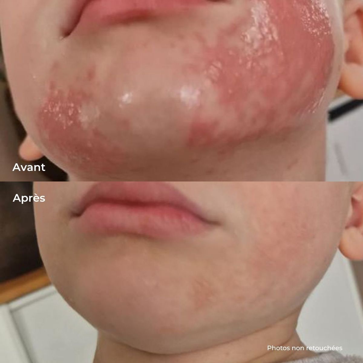 Joue d'enfant irritée avant et apaisée après le Baume Magique, photos non retouchées