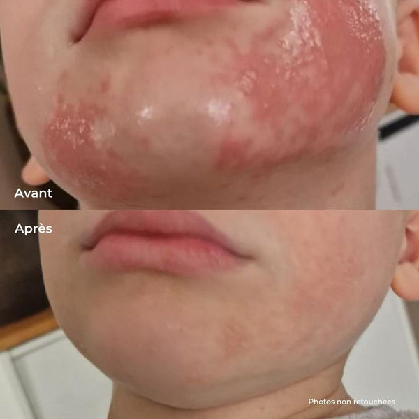 Joue d'enfant irritée avant et apaisée après le Baume Magique, photos non retouchées